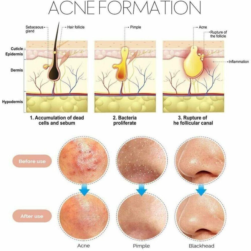 Игла для удаления угрей, набор из 4 предметов, игла для удаления угрей, многофункциональный инструмент для чистки лица, специальное средство для удаления угрей, не повреждает кожу