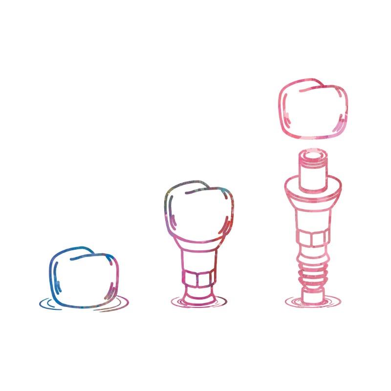 Акварельная картина на холсте «Зубной имплантат», Постер «Зубная фея», Стоматологическое искусство, Принт анатомии зуба, Настенные картины, Декор для больницы, клиники