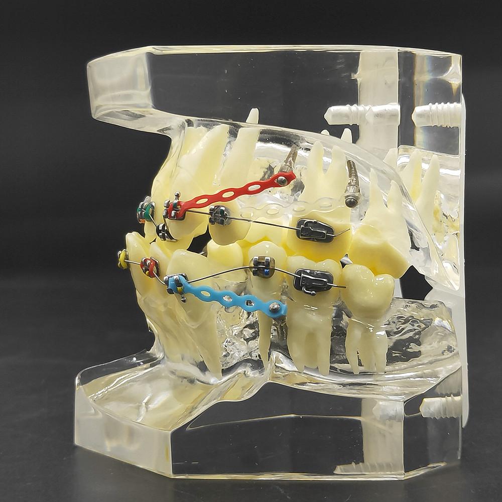 1 шт., прозрачная стоматологическая ортодонтическая модель прикуса с брекетами, буккальная трубка дуги для общения с пациентом