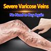 Natural Gel for Varicose Veins - Eases Swelling & Discomfort, Gentle Non-Irritating Formula