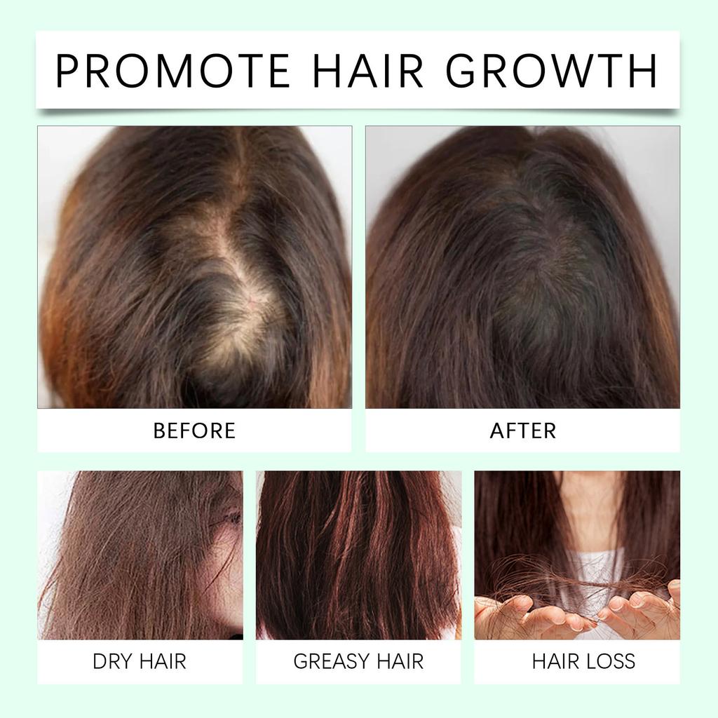 Herbal Hair Growth Spray Activates Hair Follicles, Reduces Hair Loss And Breakage, Improves Hair Quality, Nourishes Hair And Promotes Hair Growth,30ML