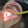 Ложка для чистки ушей Светодиодный диммируемый свет Кюретка для удаления ушной серы Пинцет для чистки ушей и носа