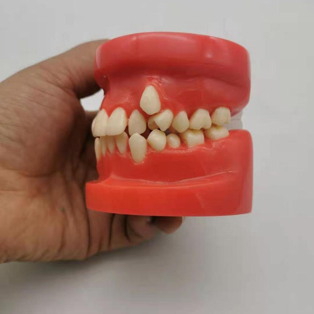 Children's Dental Malocclusion Teaching Model - Red Protrusion