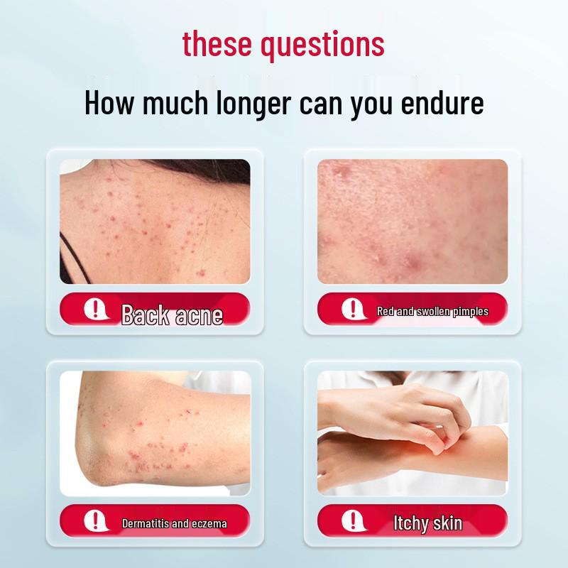 Спрей для кожи с горы Чанбай при экземе, дерматите, акне, зуде и для ухода за нехроническими ранами.