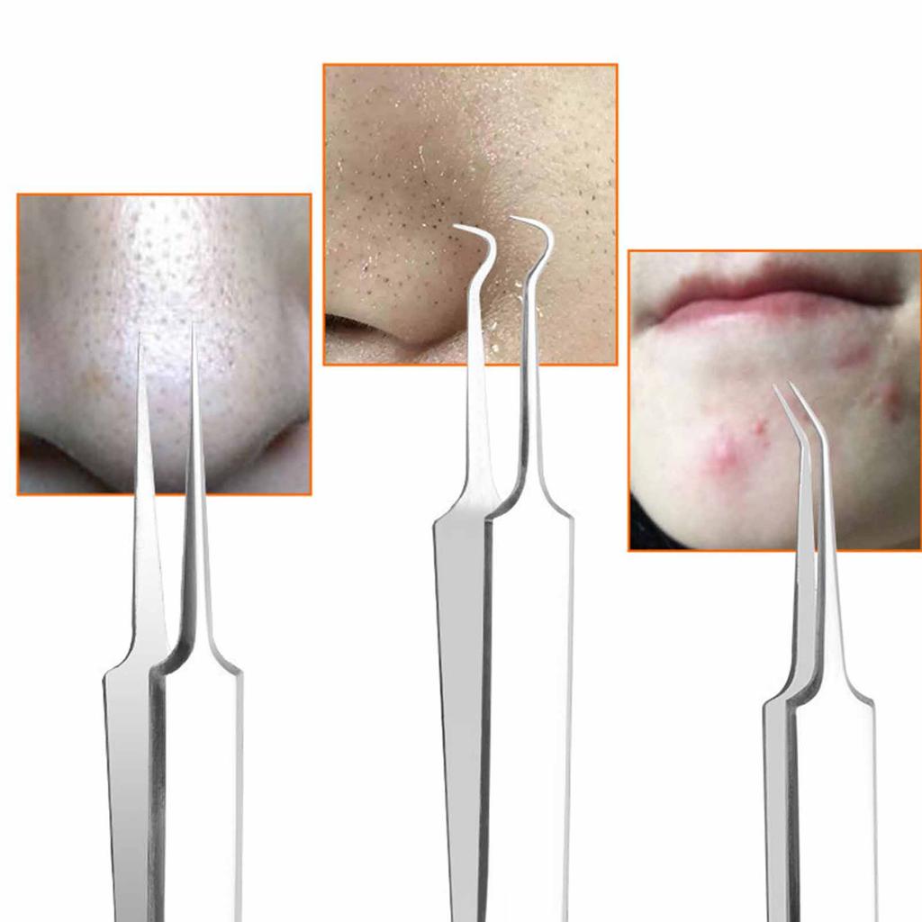 Stainless Steel Acne Extractor Tool for Blackheads and Pimples