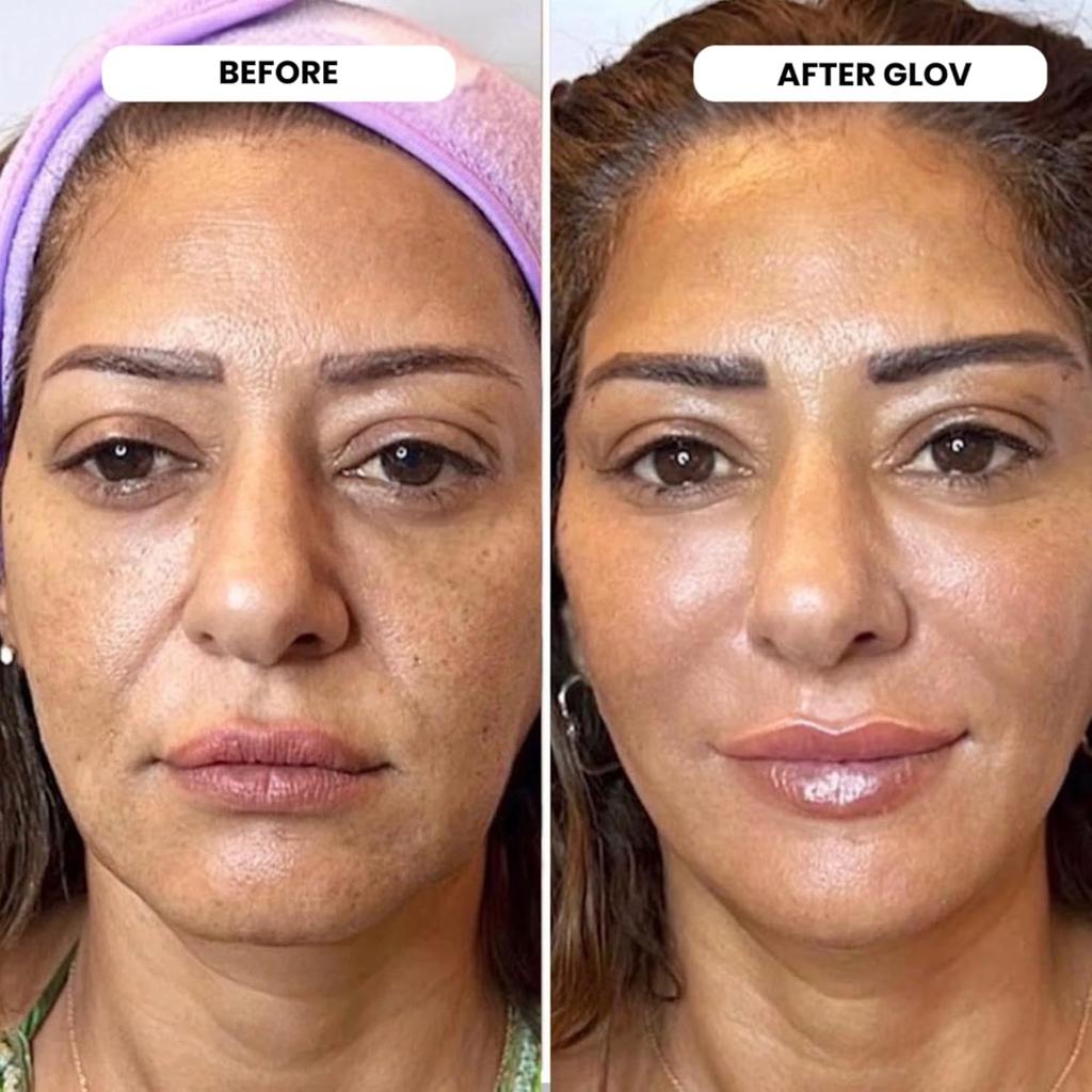 Система микроинфузий, 0,25 мм косметический штамп для лица из 24-каратного золота, ампулы с пептидной сывороткой, увлажняющий и придающий объем набор для сияния