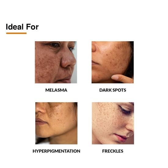 Fixderma 2% койевая кислота + 1% арбутин Skarfix-Plus крем для удаления шрамов, крем для удаления шрамов от угревой сыпи | Помогает уменьшить мелазму - 15 г (Упаковка из 2 шт.)