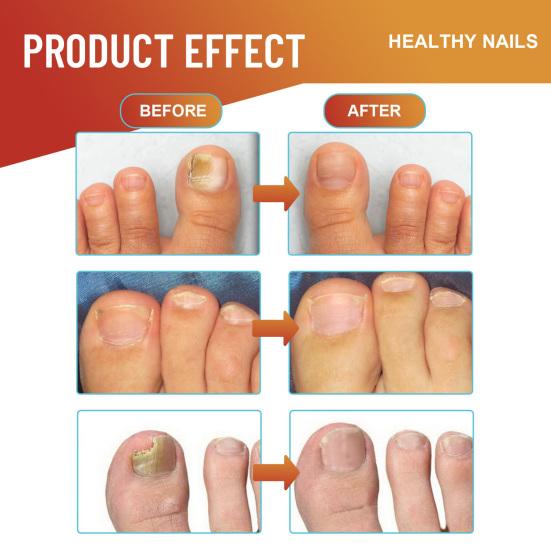 32 Pcs/Bag Toe Care Patches Safe Gentle Nail Fungus Relief Improve Nail Appearance Strengthen Nails Night Fungus Nail Patches