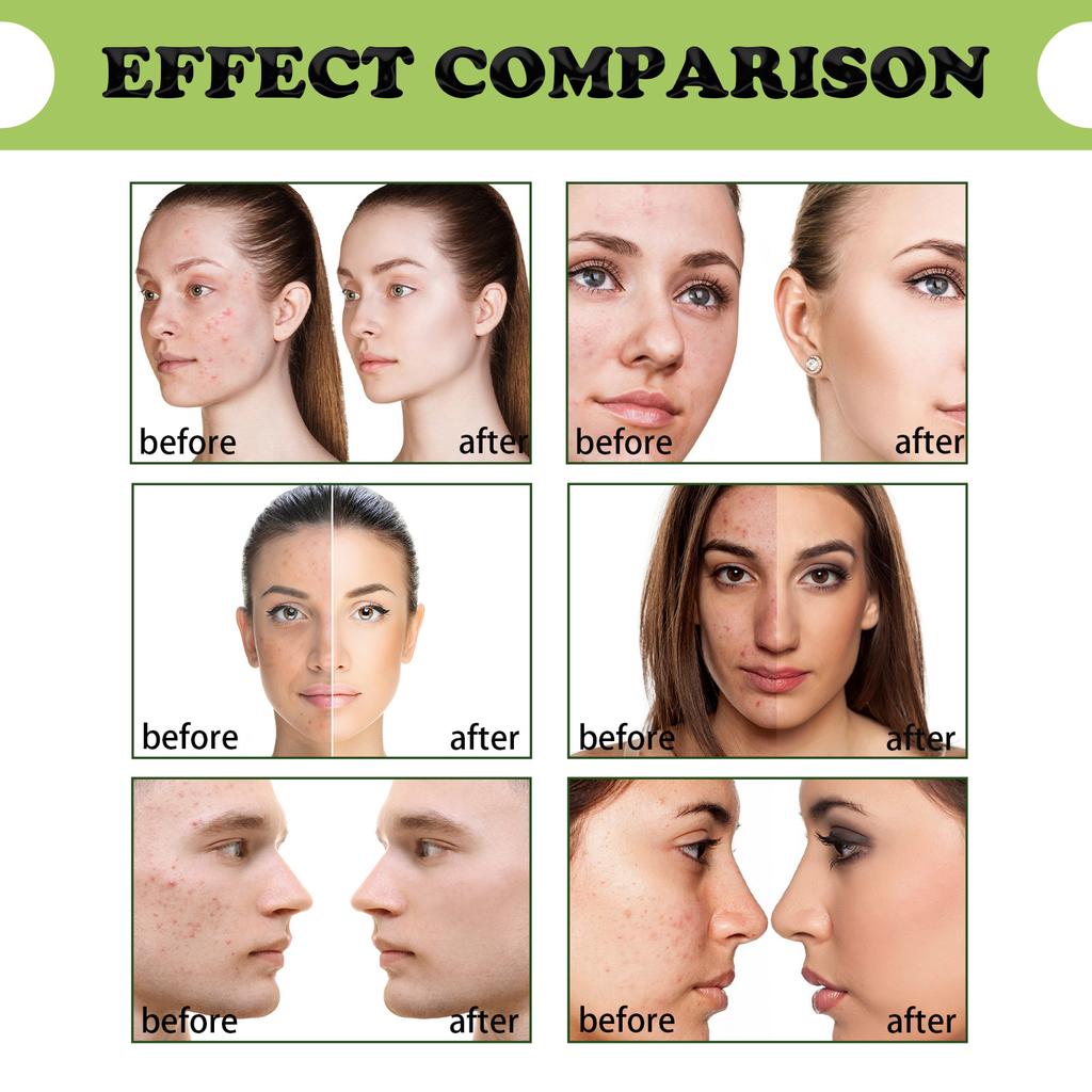 EELHOE Tea Tree Acne Repair Essence Осветляет следы от прыщей Очищает прыщи Устраняет прыщи Восстанавливает кожу Увлажняющая эссенция