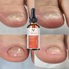 Fungal Nail Repair Spray Nursing Treatment Foot Nail Fungus Removal Gel Anti-Infective Paronychia Onychomycosis Care