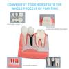 ANNWAN Dental Implant Model 4 Times Removable Analysis Crown Bridge Demonstration Teeth Model for Class Education and Studying Teeth Model