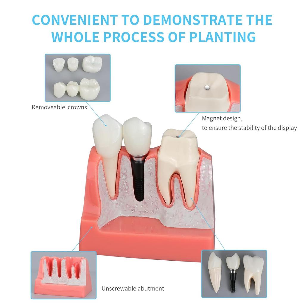 ANNWAN Dental Implant Model 4 Times Removable Analysis Crown Bridge Demonstration Teeth Model for Class Education and Studying Teeth Model