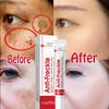 New Powerful Spot-Removing Whiten Cream Brighten Skin Fast Eliminates Melanin Pigmentation Melasma Dark Spots Korean Skin Care