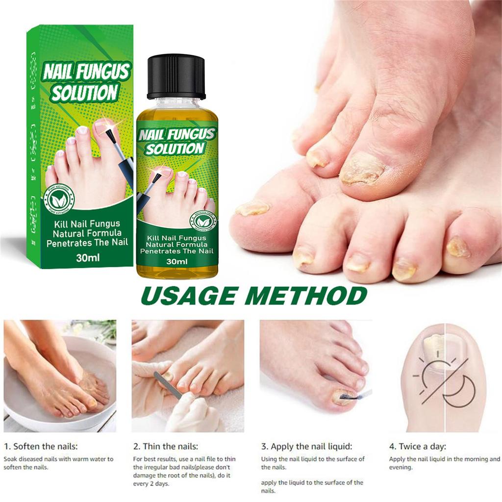 Toenail Fungus Care, FastActing Nail Care Liquid For Fungus Under & Around Restores The Healthy Appearance Of Nails 30ml