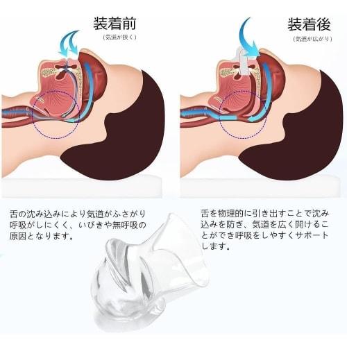 Snoring Mouthpiece, Tongue Mouthpiece, Snoring Prevention Aid, Sleep Apnea Prevention, Snoring Relief, Sleep Noise Reduction, Mouth Breathing, Include