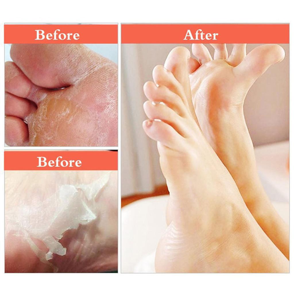 Foot Mask Exfoliating And Moisturizing Foot Mask Removing Dead Skin On The Heel And Moisturizing Foot Mask For Both Men And Women 70ml