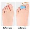 1Pc Overlapping Toe Separator Orthopedic Bunion Valgus Hammertoe Corrector Pain Relief Women Men Foot Alignment Toe Spacer Hammer Toe Straightener