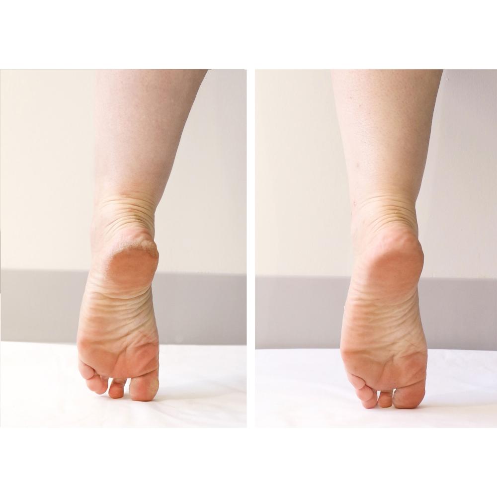 Patchology PoshPeel Pedi Cure Intensive Foot Peel Treatment Standard