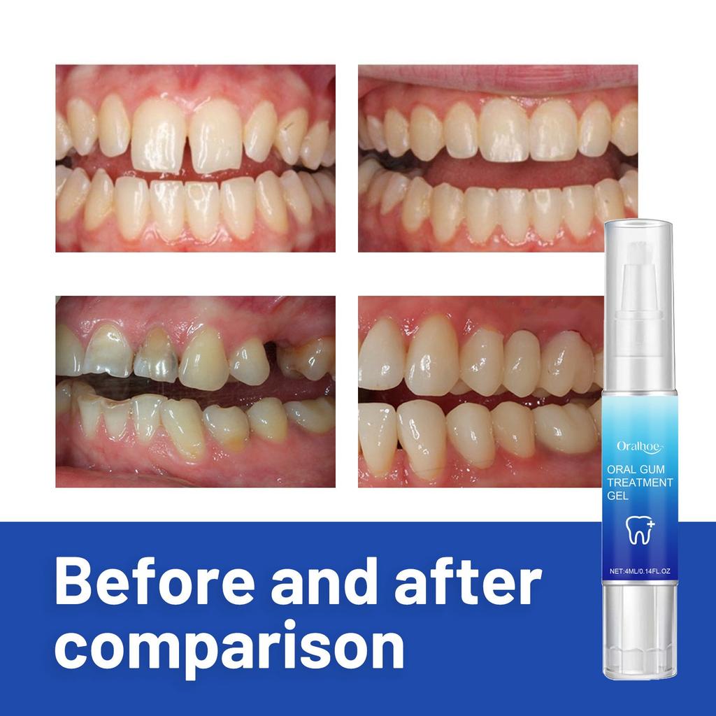Gingival Gel Relieves Swelling And Pain Of Gums Cleans Tooth Stains Tooth Yellows Fresh Breath Care  4ml