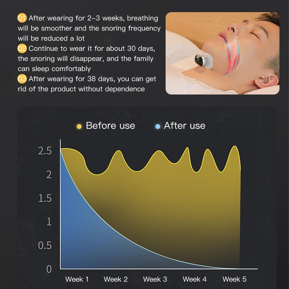 Электрический интеллектуальный фиксатор храпа EMS Импульсное устройство против храпа Эффективное решение Средство от храпа при апноэ во сне Снижение шума Анти-Ронко