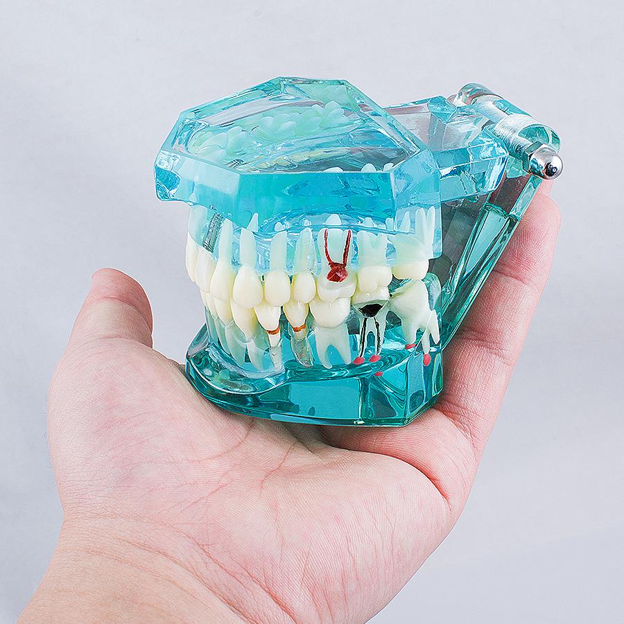 Dental Study Tooth Transparent Adult Pathological Teeth Model