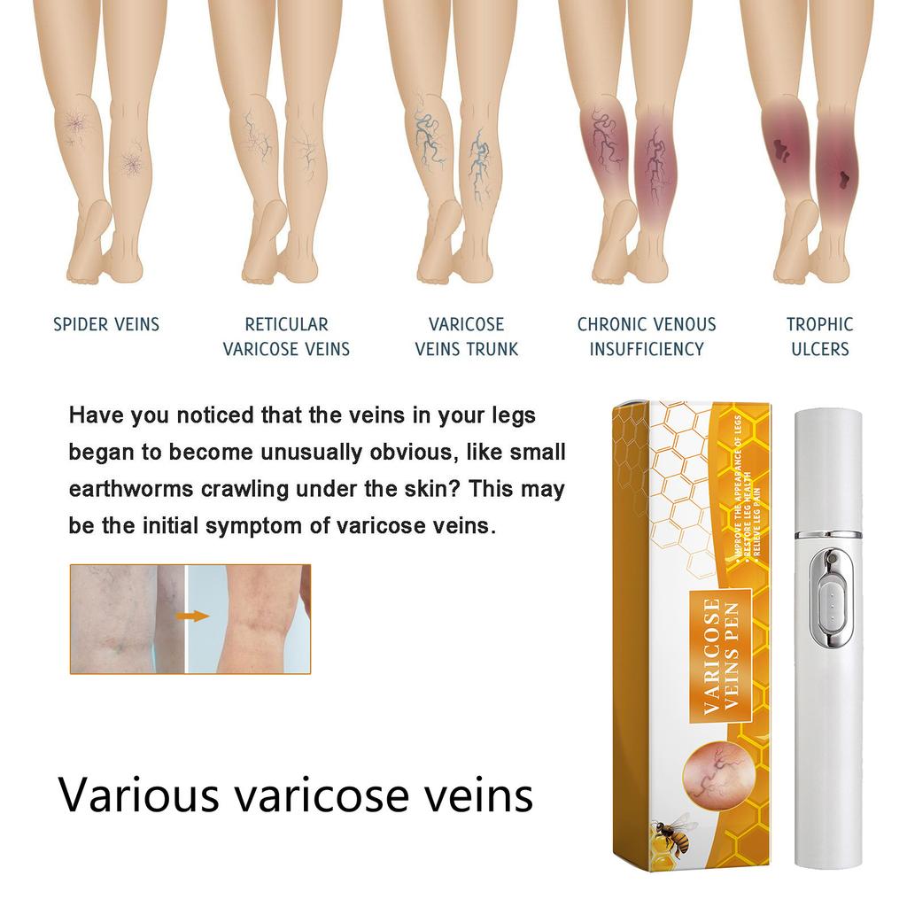 Ручка для лечения варикозного расширения вен Ручка для снятия дискомфорта при вздутии ног Ручка для расслабления ног Ручка для абажурной терапии Ручка для восстановления ног