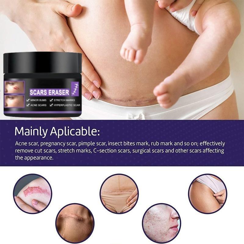 Крем для восстановления рубцов, обессоливание послеоперационных шрамов, гладкая кожа, восстановление кожных ран, увлажняющий крем для ухода за кожей