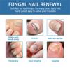 Средство от грибка ногтей на ногах, быстродействующий жидкий спрей для ухода за ногтями от грибка под ногтями и вокруг них, восстанавливает здоровый вид ногтей 30 мл