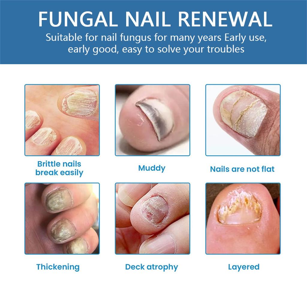 Средство от грибка ногтей на ногах, быстродействующий жидкий спрей для ухода за ногтями от грибка под ногтями и вокруг них, восстанавливает здоровый вид ногтей 30 мл