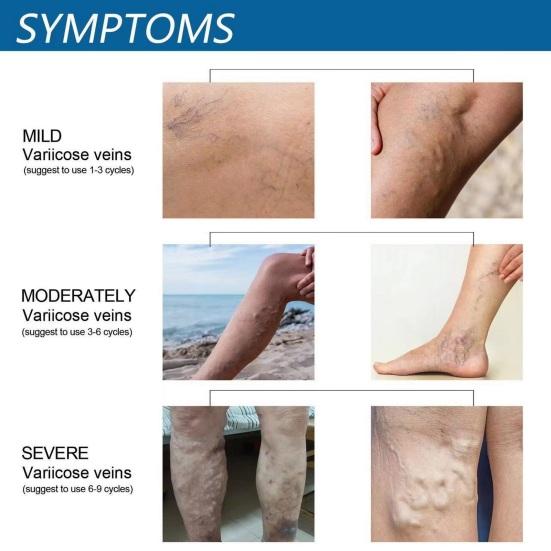 30 мл спрей для массажа варикозных вен снимает дискомфорт в ногах улучшает кровообращение мягкий эффективный спрей для варикозного расширения вен