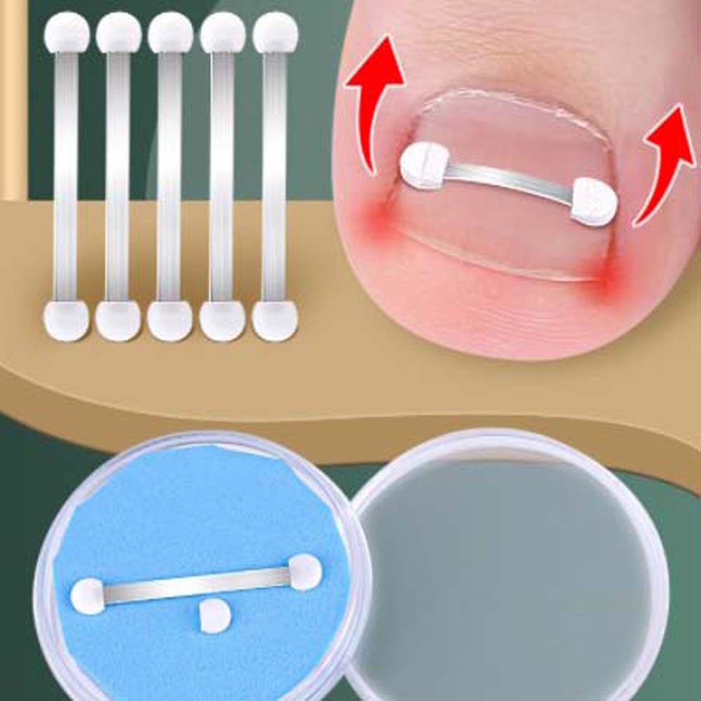 Support Toe Braces Bunion Corrector Ingrown Toenails Corrector Toenail Straightener Toenail Fixer