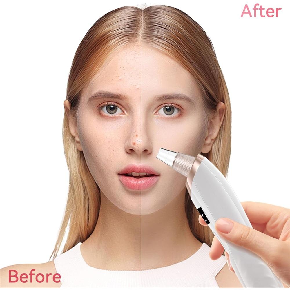 Electric Blackhead Vacuum Cleaner 4-Level Suction Modes Blackhead Removal Tool with Heating Mode