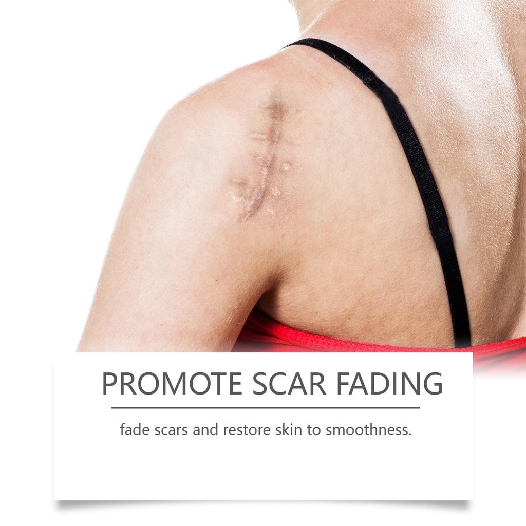 Ухаживающий гель от акне, растяжек, пигментных пятен беременности, отложения меланина, мягкий и успокаивающий, эффективно осветляет следы от шрамов