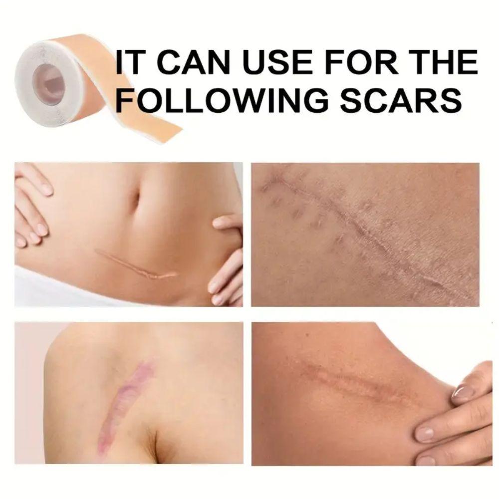 Самоклеящаяся лента для лечения рубцов, многоразовые пластыри для ухода за рубцами, для покрытия пятен на теле и шрамов