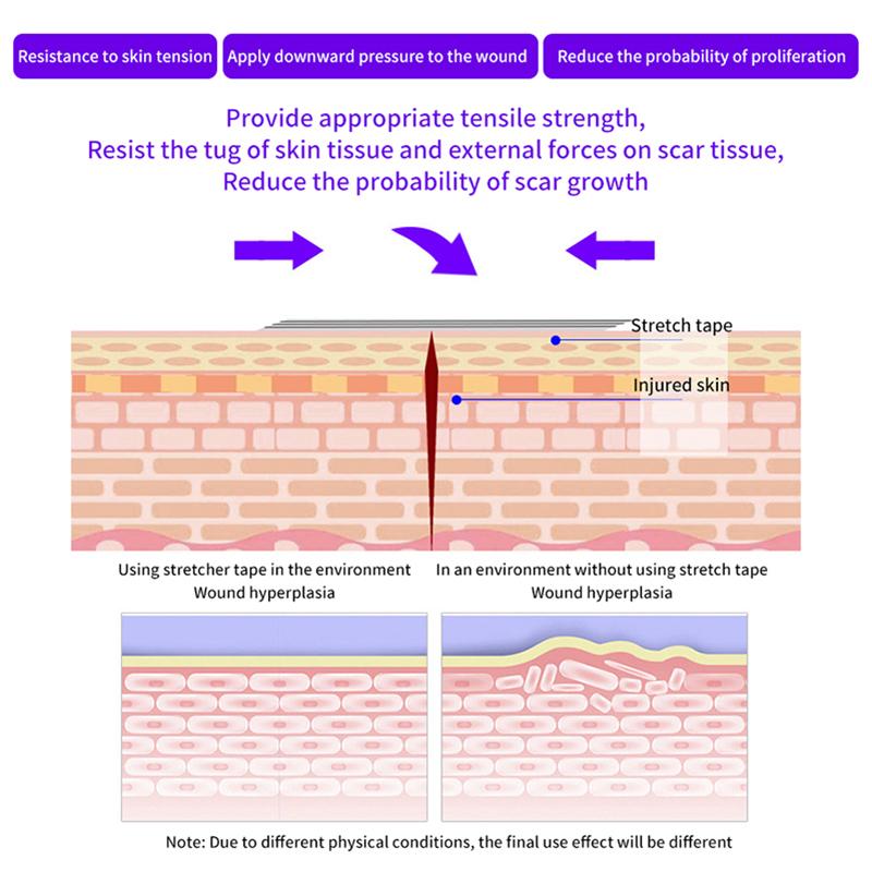 Стерильная полоска для удаления шрамов, следов от угревой сыпи, стерильный пластырь для первой помощи, дорожный хирургический пластырь для закрытия ран