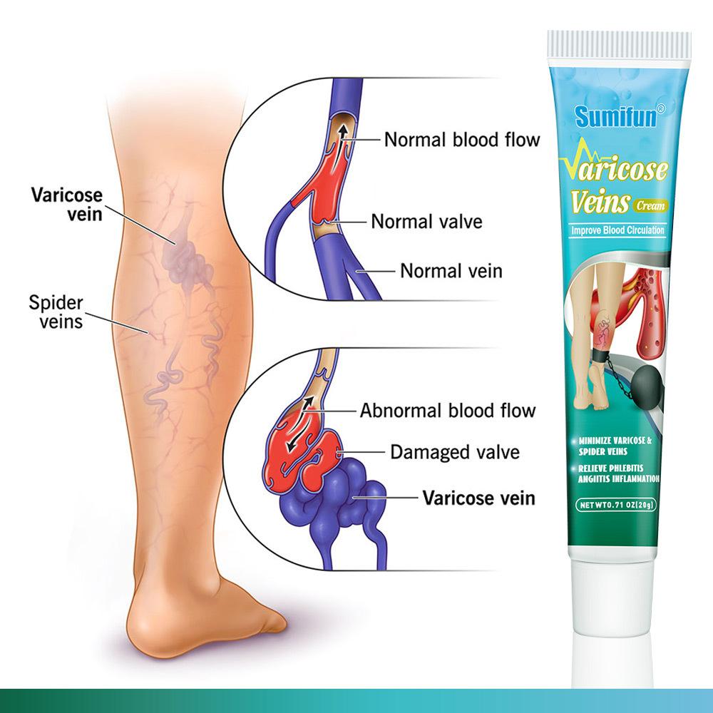 Sumifun Крем от варикозного расширения вен, травяная мазь