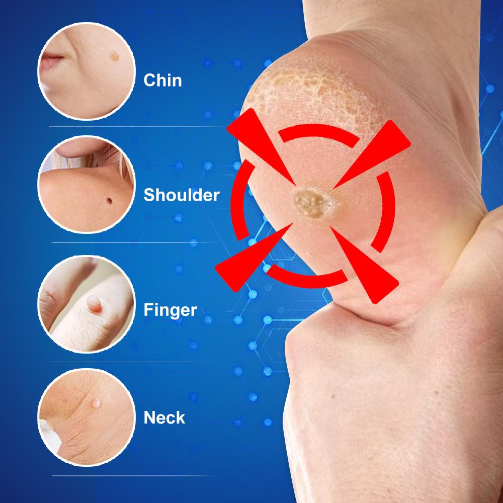 20 г крем для удаления мозолей на ногах Killer Foot Protection обезболивающий лечебный крем для лечения мозолей