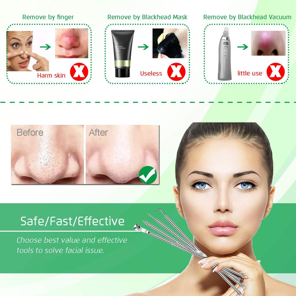 5PCS Blackhead Remover Comedone Extractor, Curved Blackhead Tweezers Kit, Professional Stainless Pimple Acne Blemish Removal Too