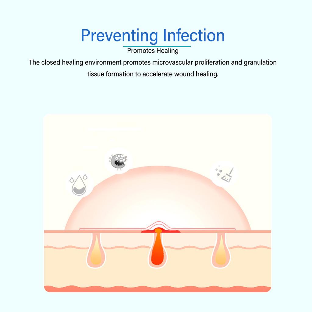 5 шт. Гидроколлоидная гелевая повязка Прозрачная водонепроницаемая гидроколлоидная раневая повязка
