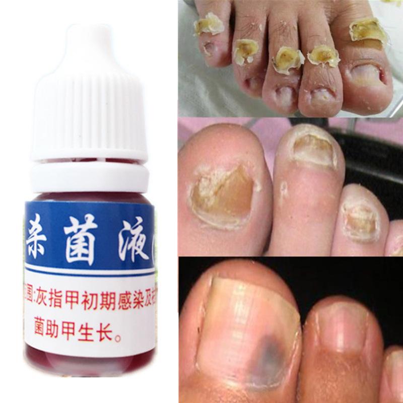 Anti Fungus Nail Onychomycosis Nail Repair Treatment Liquid Cleanser Herbal Disinfection Serum