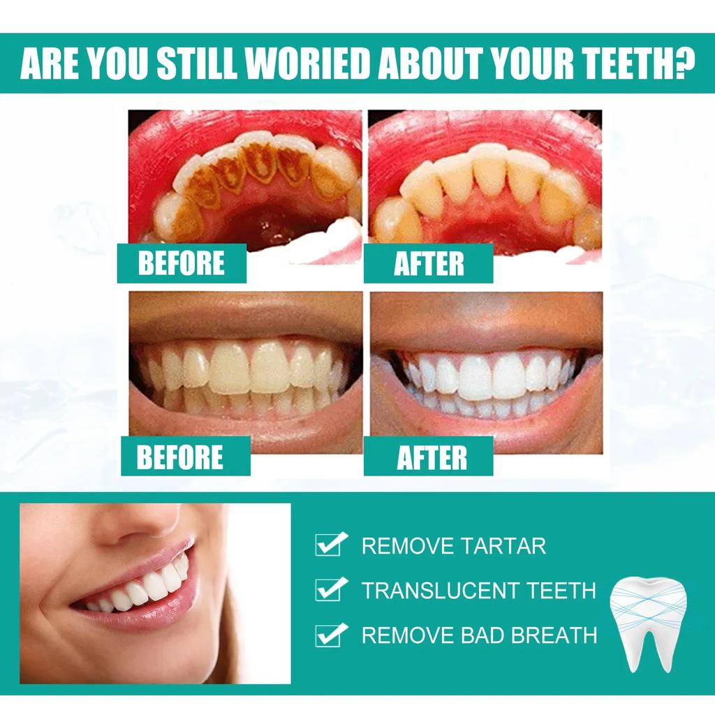 Спрей для удаления зубного камня для отбеливания зубов и удаления зубного налета