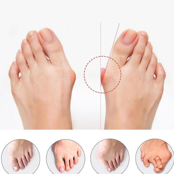 Корректор для разделителя пальцев ног SEBS Toe Pad Straightener Инструмент для ухода за ногами Новый