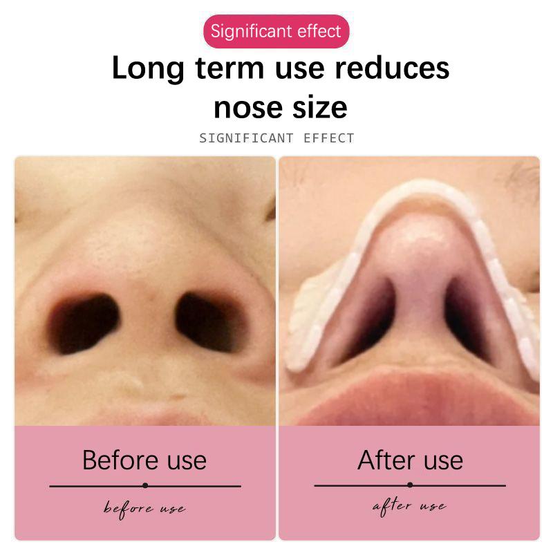 Низкотемпературная термопластичная носовая шина Пластическая хирургия Пластиковая пластина Ортопедический ортопедический фиксатор