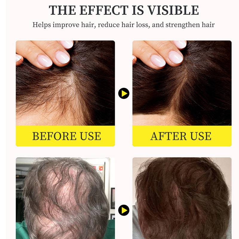 Рост волос Сыворотка для волос Укрепляет волосы Уменьшение выпадения волос Уход за кожей головы Имбирное масло
