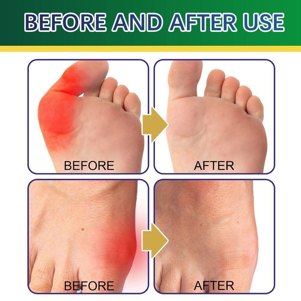 Natural Herbal Bunion Patch - Gentle Comfort for Toe Alignment