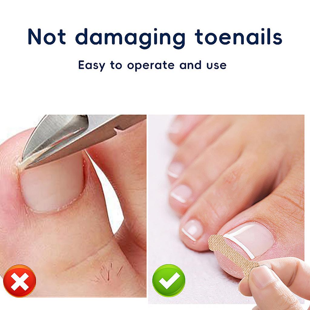 60PCS Nail Correction Patch Breathable Ingrown Toenail Sticker Nail Care Strips Customs Name: Plastic Patch
