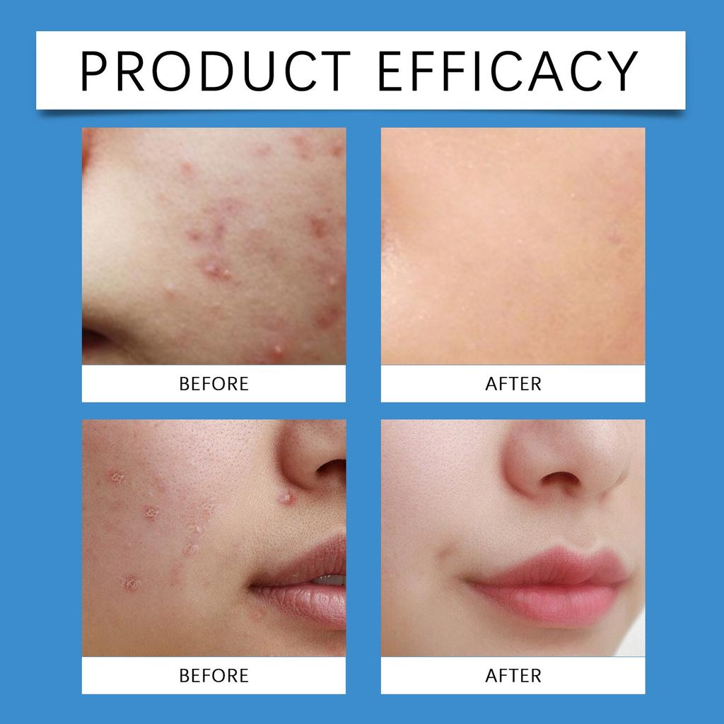 Traceless Acne Patch Lightweight Skin Friendly Acne Patch Absorb Pus Anti-Acne Concealer Transparent Round Hydrocolloid Hypoallergenic Acne