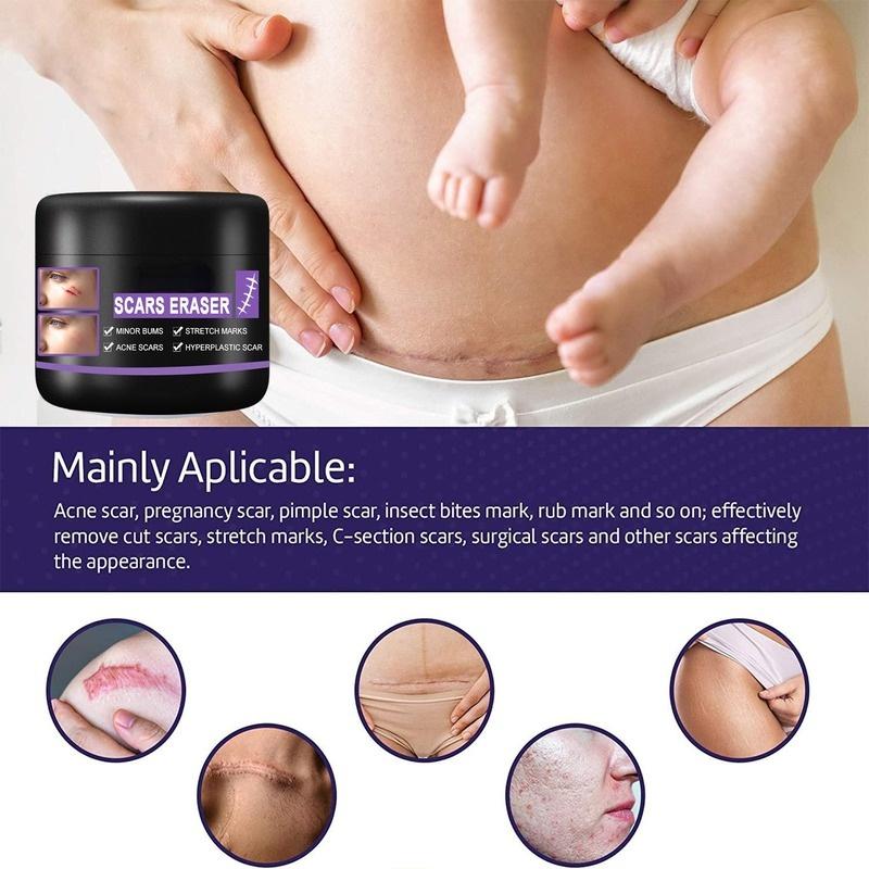 Крем для восстановления рубцов, обессоливание послеоперационных шрамов, гладкая кожа, восстановление кожных ран, увлажняющий крем для ухода за кожей