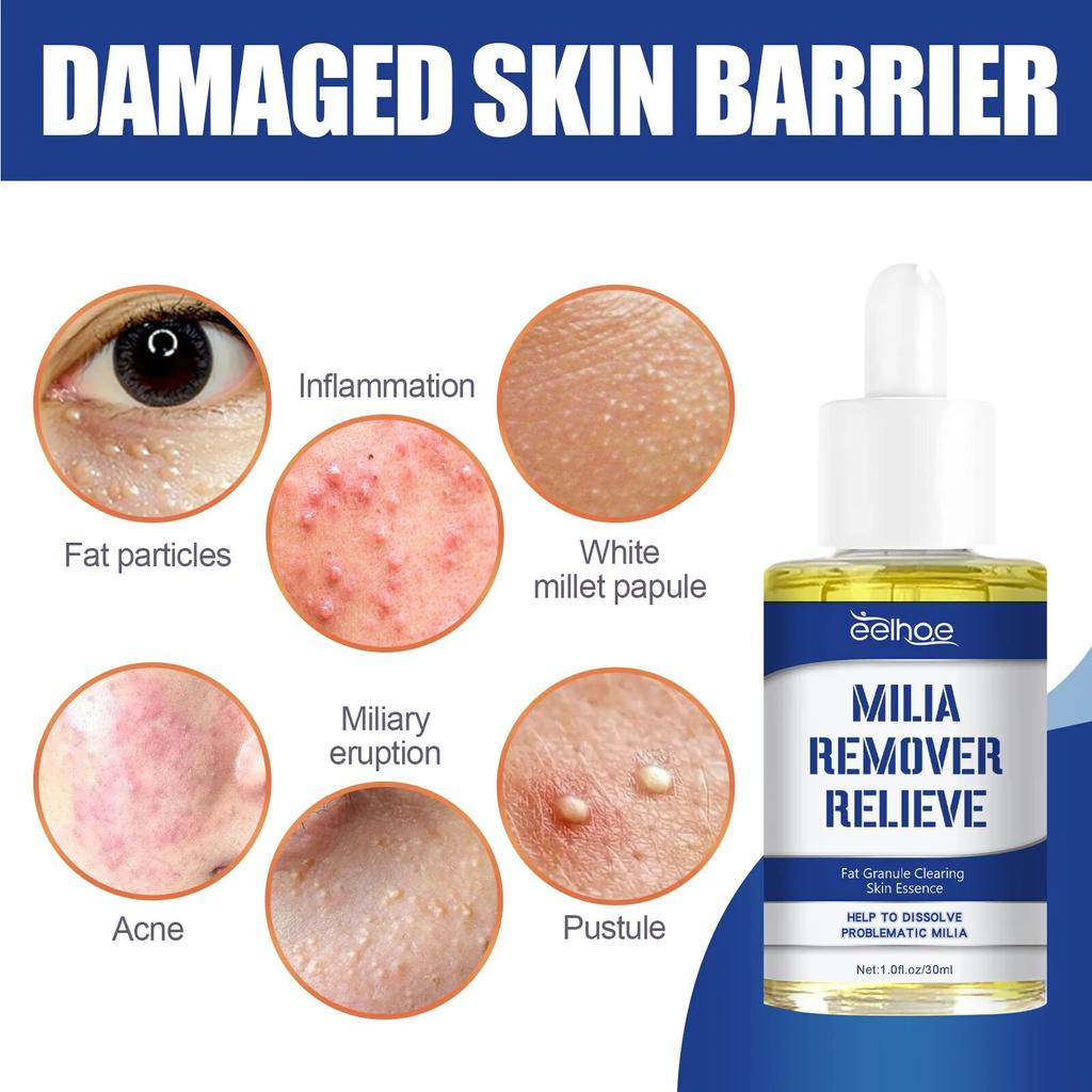 Сыворотка для удаления жировых гранул под глазами, восстановление милиумов, контроль жирности, противовоспалительная отечность, гладкое увлажнение, лечение милиумов