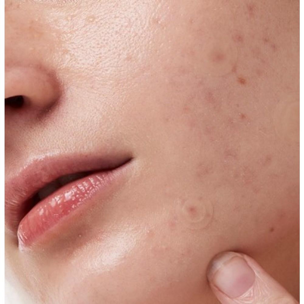 Пластырь для проблемной кожи Idewcare Time Out Blemish Patch Plus, 36 шт., 1 шт.